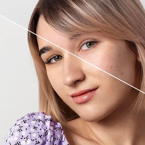 6 Ways to Get Rid of Acne Fast